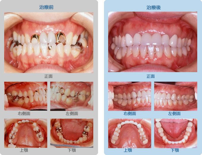 審美歯科症例2