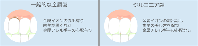 一般的な金属製の義歯とジルコニア製の義歯の違いの画像
