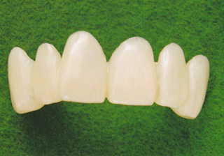 前歯の強化プラスチック製
